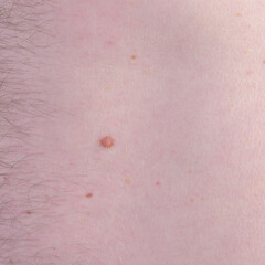 Fototapeta premium Close-up of human body showing nevus on skin with natural texture and pigmentation