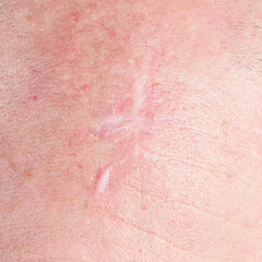 Fototapeta premium Close up of skin after cancer surgery with visible scar highlighting early detection and skin cancer awareness