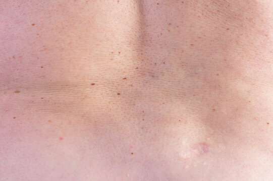 Close-up of human back skin showing multiple nevi and a surgical scar with natural texture