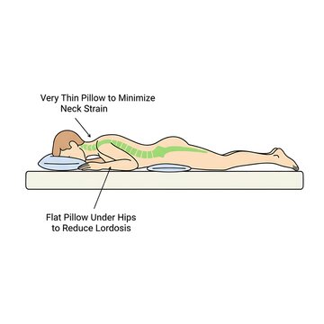 Medical illustration showing correct prone sleeping position with thin neck pillow and flat hip support to minimize lordosis spine strain