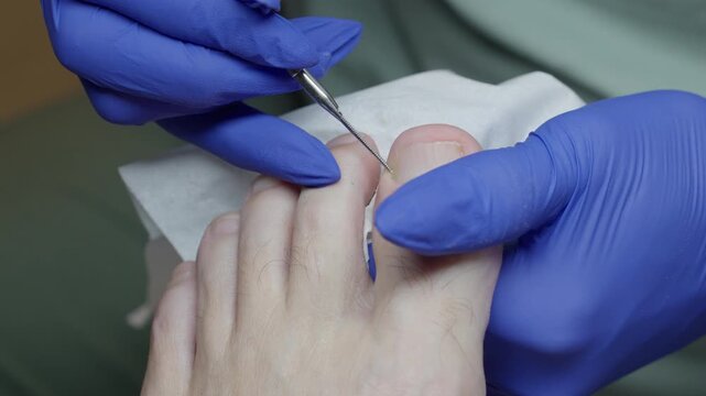 Foot care procedure. The pedicurist gently pushes back the cuticle on the toe and squeezes out a drop of pus