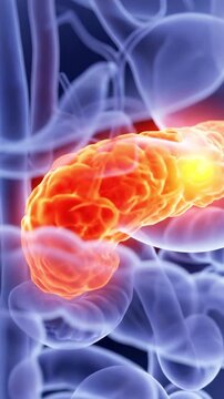 Diseased human pancreas with inflammation or tumor highlighted in a 3d render, suitable for medical illustration, health education, scientific research, and anatomy study.