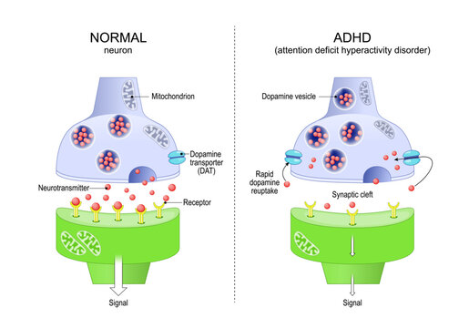Normal neuron and ADHD neuron. Attention deficit hyperactivity disorder.