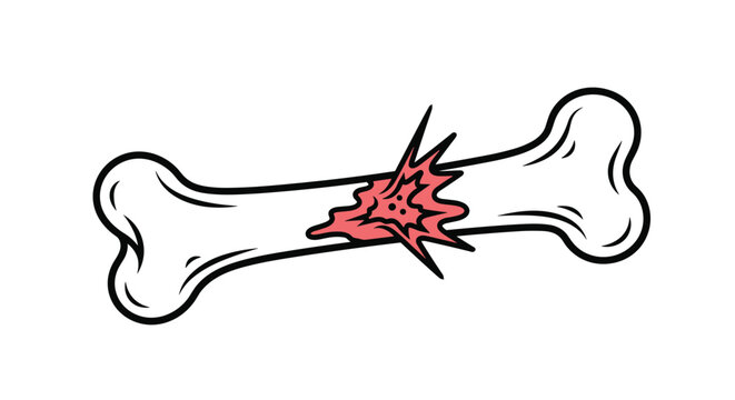 Medical illustration of a human bone with a significant fracture and red pain indicator at the center to represent a skeletal injury.