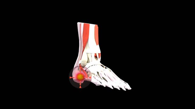 3D Foot Pain | Alpha Channel