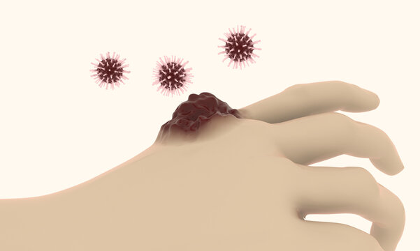 Viral infection gene mutation