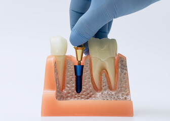 Gloved hand demonstrating dental implant placement in model © Maximusdn