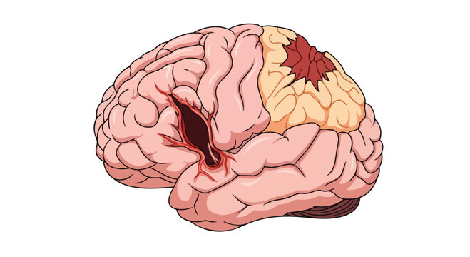 Illustration of a human brain with a visible injury and damaged tissue on the frontal lobe area