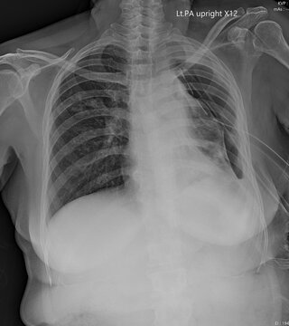 Medical Chest X-ray of Pneumothorax Featuring Intercostal Chest Drain Tube for Lung Re-expansion.