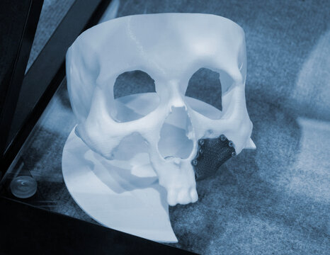 Prototype of a human skull from white plastic with an implant from biocompatible titanium printed on a 3D printer. Bioengineering patient-specific slit-facial prosthesis.