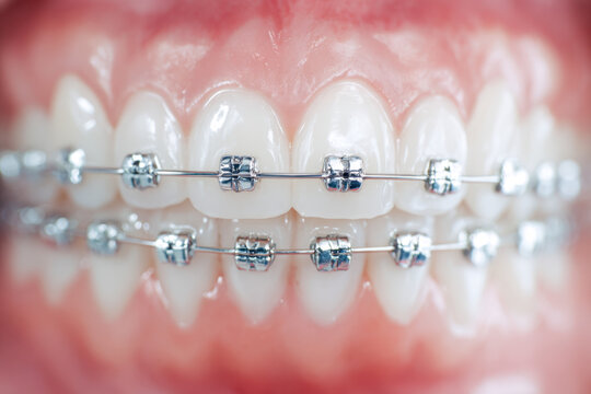 Detailed view of teeth with metal braces orthodontic treatment showing brackets and archwires for dental alignment and straightening care in oral health management