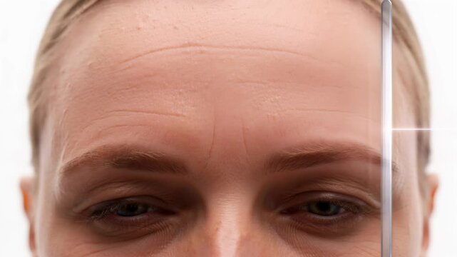 Close-up of a woman's forehead with deep wrinkles being scanned by a futuristic laser light beam for anti-aging skin treatment and dermatological analysis in a beauty clinic.