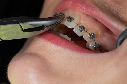 Dental braces examination, ororthodontic consultation