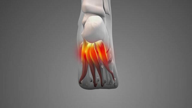 Plantar Fascia Strain Leading to Foot Pain