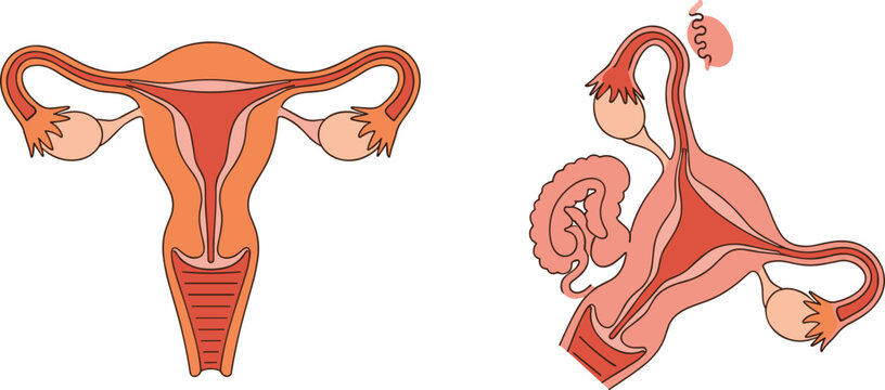 An illustrative comparison depicts a normal uterus and fallopian tubes alongside a uterus affected by endometriosis high quality professional detailed modern elegant stylish