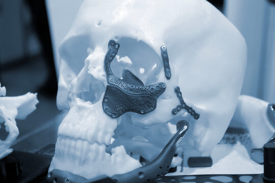 Prototype of human skull from white plastic with titanium implants of plates and surgical templates printed on 3D printer. Biointegrated prosthesis. Medicine medical. Endoprosthesis