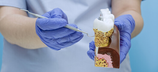 Dentist pointing at dental tartar and gum disease on anatomical tooth model with professional probe.