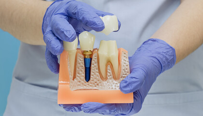 Comparison of a happy healthy tooth toy and a realistic decayed tooth model with caries and pulpitis.