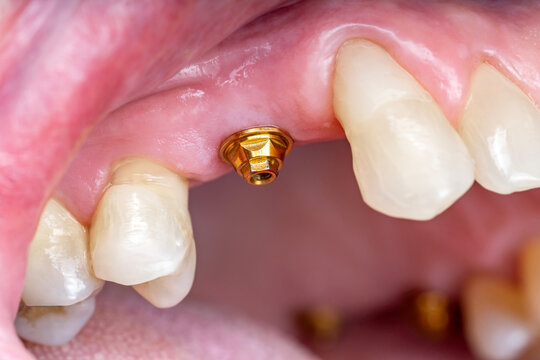 Close-up of dental implant healing abutment in gum