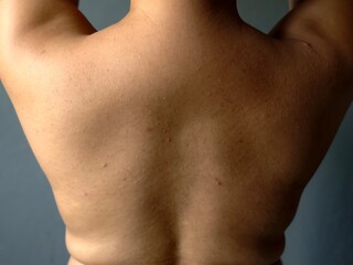 Naklejka premium Back view of a woman with back acne, uneven skin texture, and excess fat. Concept of body care, skin problems, weight gain, and fitness.