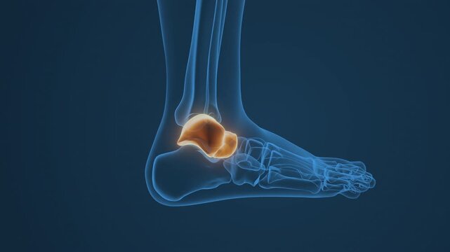 Talus Bone Inflammatory Condition of Ankle