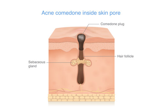 Acne comedones and blackhead formation in a clogged skin pore, Sebum buildup inside the hair follicle. Medical illustration about skin layer with acne for beauty treatment.