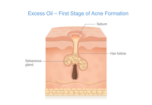 Excess oil buildup clogged in a skin pore, the first stage of acne formation in human skin. Medical illustration of sebum inside a skin pore layer of oily skin people.
