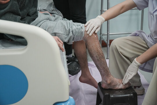 Prosthetist making a plaster cast of a patient's leg for a custom Ankle Foot Orthosis (AFO). Professional orthotic fitting process in a rehabilitation clinic.
