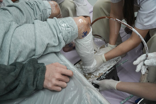 Prosthetist making a plaster cast of a patient's leg for a custom Ankle Foot Orthosis (AFO). Professional orthotic fitting process in a rehabilitation clinic.