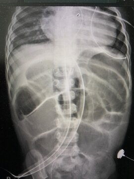 Film x-ray show diffusely dilated bowel loops, bowel ileus for medical and technology concept