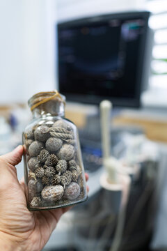 Hand holding glass bottle filled with removed kidney stones. Close up of glass jar containing various sizes of urinary calculi against blurred medical background.