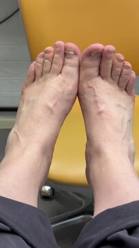Man feet with discolored toenail closeup, sitting in yellow clinic armchair before nail plate debridement, visible surgical scars.
