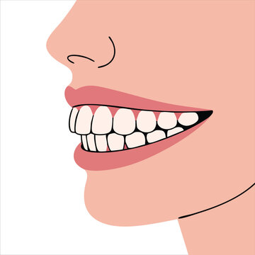Overbite Teeth Condition Face Close Up Side View Dental Health Vector Illustration