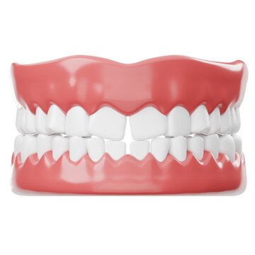3D Render of Gapped Teeth