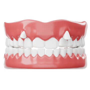3D Render of Malocclusion Teeth