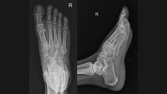 Right Foot X‑ray, Dorsoplantar and Lateral Views