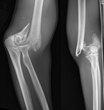 Medical X-ray of Elbow Joint Showing Distal Humerus Fracture and Supracondylar Trauma.