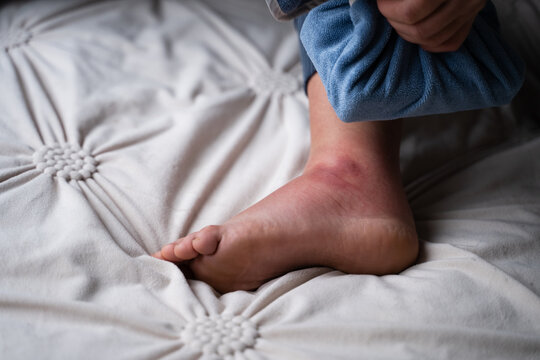 Ankle injury. Ice pack in a towel on swollen ankle after injury for first aid at home.