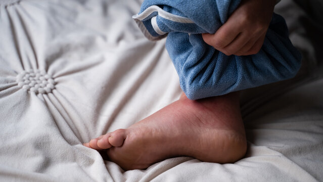Close-up of a female applying a cold pack to an ankle injury against beige blanket background. Home healthcare rehabilitation.