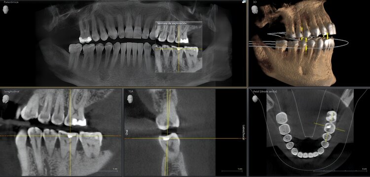 Dental cone beam computed tomography scan showing tooth analysis