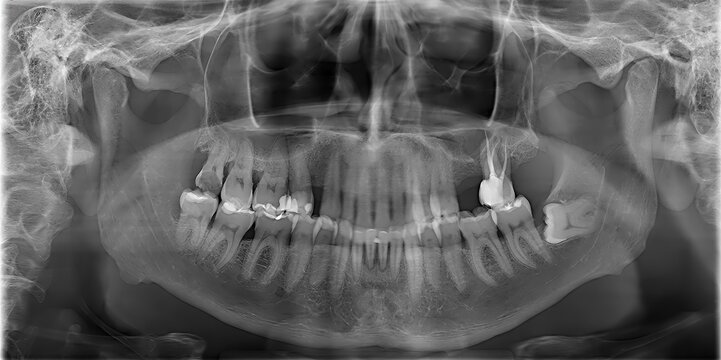 Panoramic dental x ray showing teeth and jawbone