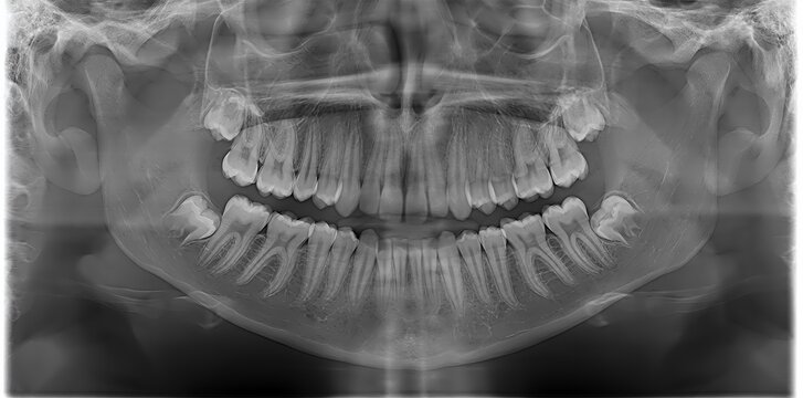 Panoramic dental x ray showing human teeth jaw