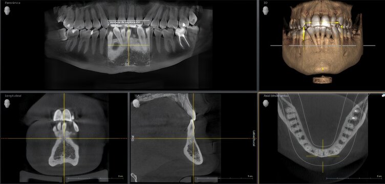 Dental cbct scan showing jaw and teeth analysis