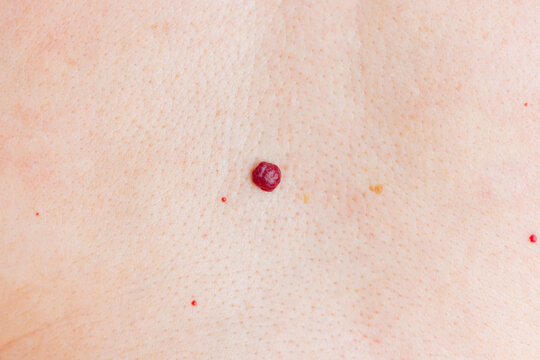 Close-up shot of red benign vascular hemangioma on human skin. Skin diseases. Laser removal.