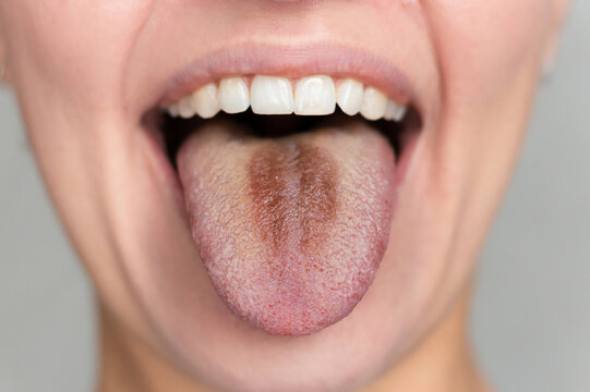Caucasian woman opening her mouth and showing a tongue with white plaque and brown spot close-up. Gastrointestinal diseases.