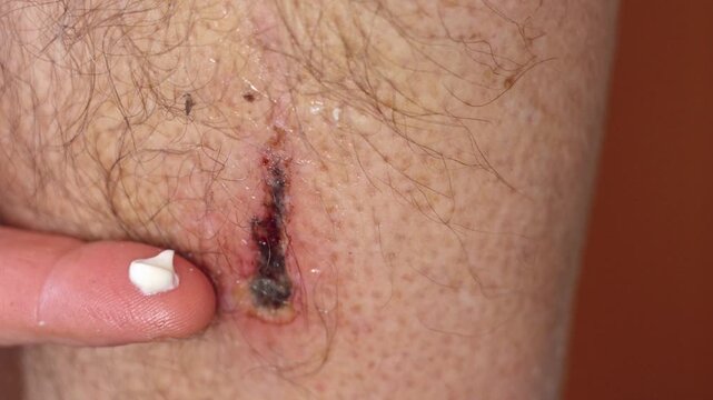 A detailed 4K slow-motion shot of a 66-year-old man's lower leg showing a concerning skin lesion. The footage features a dark, irregular-shaped mark that resembles a melanoma, atypical mole, or skin c