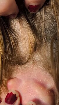 Seborrheic dermatitis on a woman's scalp. Scalpel of the head in dandruff. Peeling, itching of the skin near the blond hair on the head.