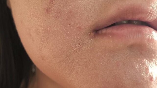 A purulent pimple near the lip on the chin of a young woman. Acne in adolescents.