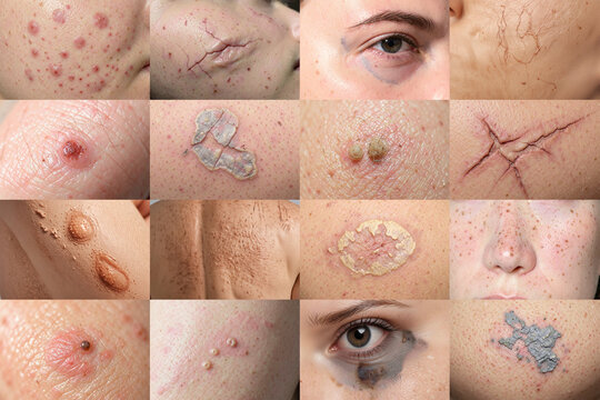 Common skin problems and dermatological conditions set, ai generated. Collage of various people facial problem close up. Medical and healthcare concept acne, irritation, dryness, lesions skin texture.