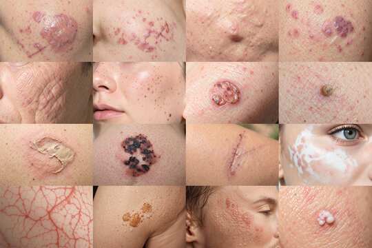 Common skin problems and dermatological conditions set, ai generated. Various problem dermatology symptom with acne, moles, scars, rashes, vitiligo and skin lesions. Medical concept and skin disease.